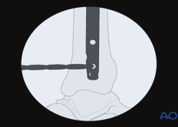 Where to Find Fracture Case Items? Check Out These Tips!